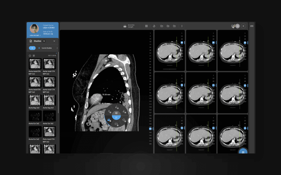 OmegaAI viewer showing CT measurements across a series